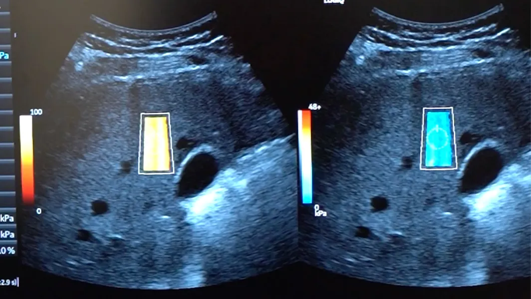 Elastografía por ultrasonido: ya contamos con examen clave para medir la salud del hígado
