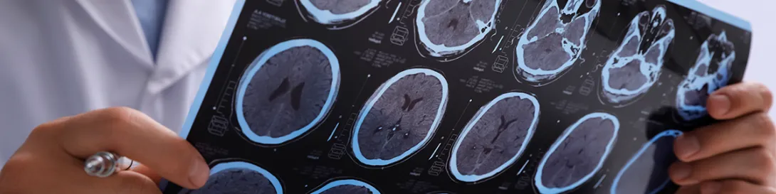 Epilepsia